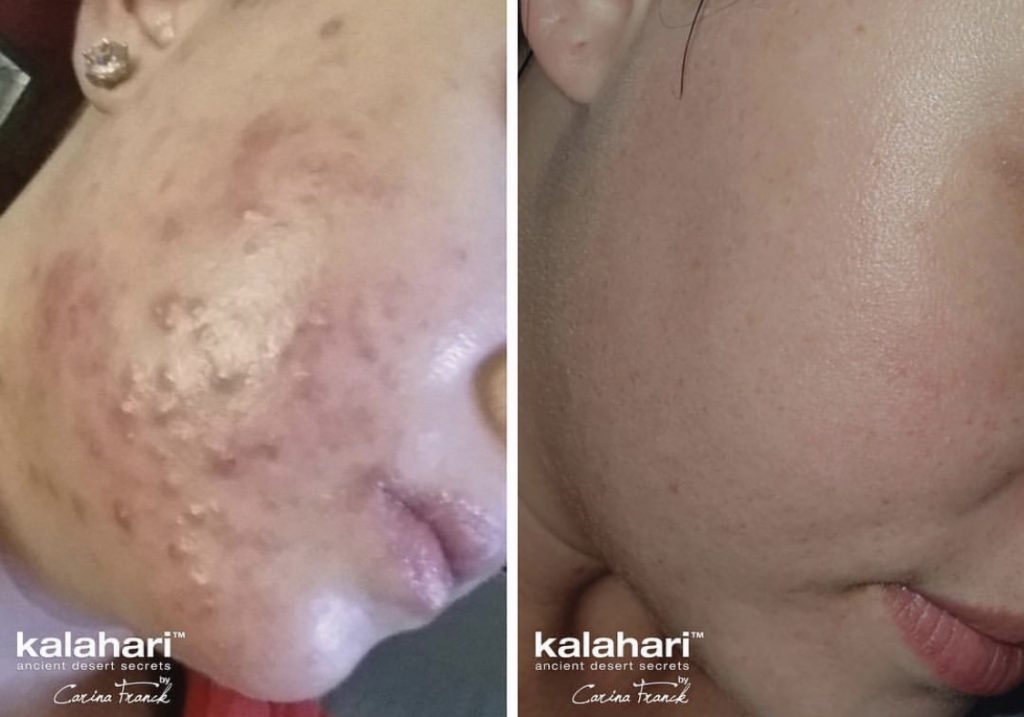 Kalahari Lifestyle Adult Acne Treatment Kalahari Lifestyle Adult Acne Treatment